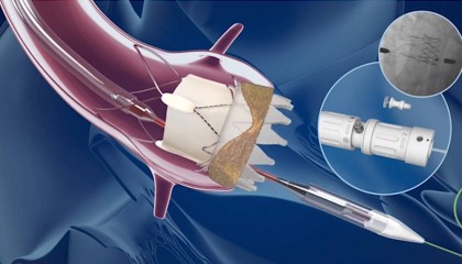独家|监管挑战加剧,波士顿科学退出全球心脏瓣膜业务