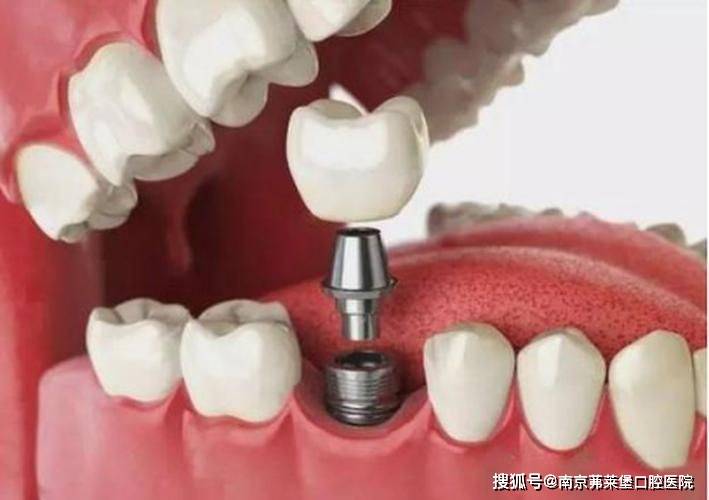南京无痛种植牙医院：镶牙和种牙哪种方式好